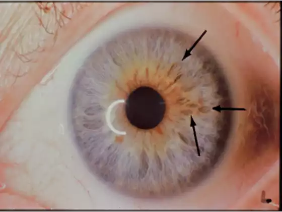 Introduction to Herbs & Iridology